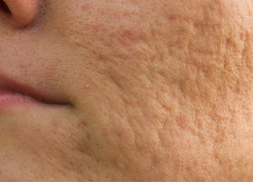 Acne scars on a woman's face