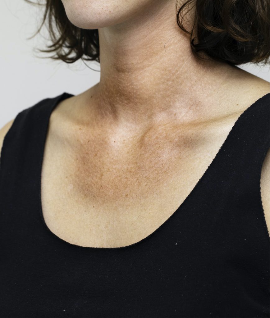 Sun damage on a woman's neck