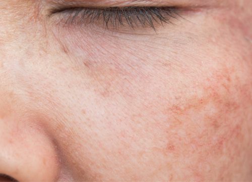 Hyperpigmentation on a woman's face