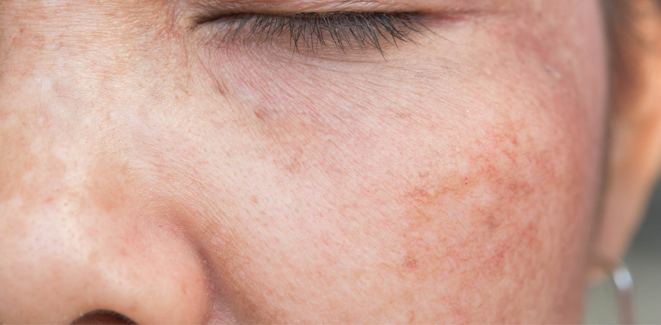 Hyperpigmentation