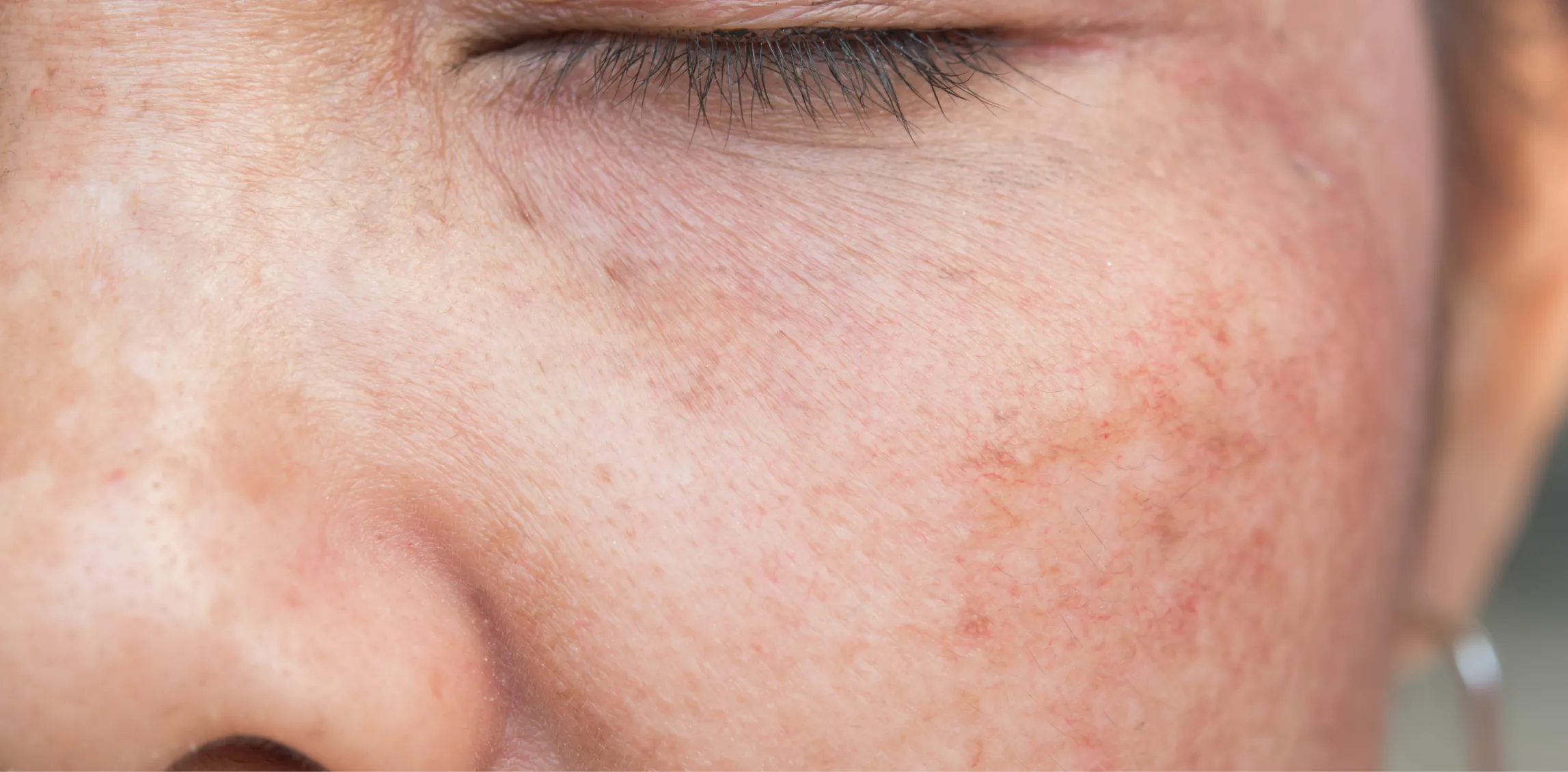 Hyperpigmentation