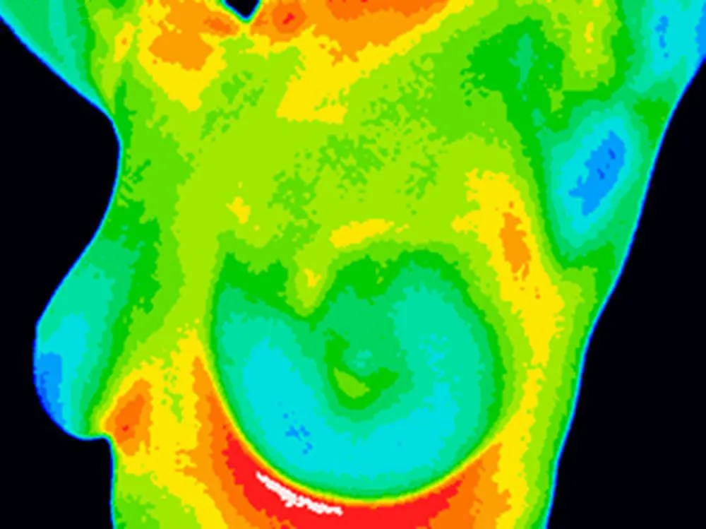The Dilemma of Mammography