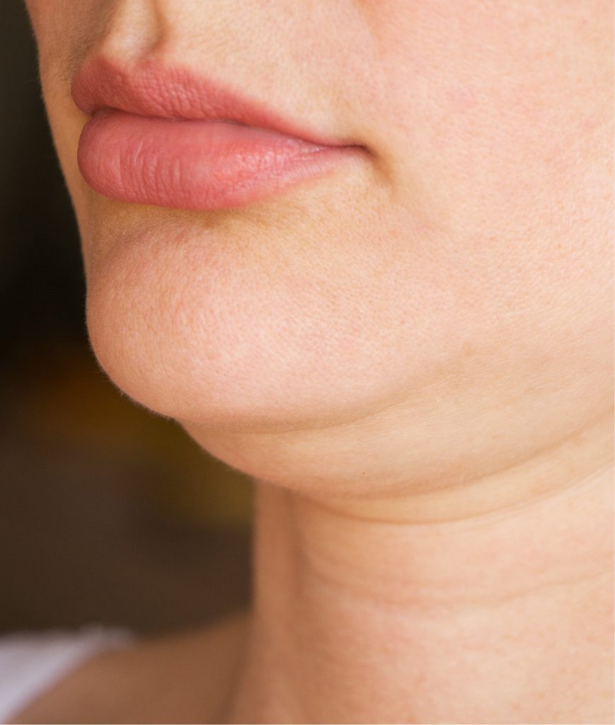 Double chin