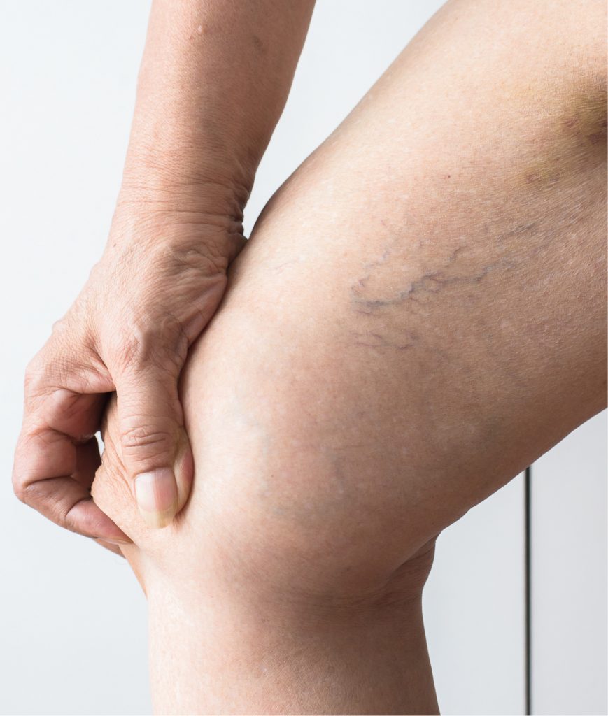 Varicose veins on a leg