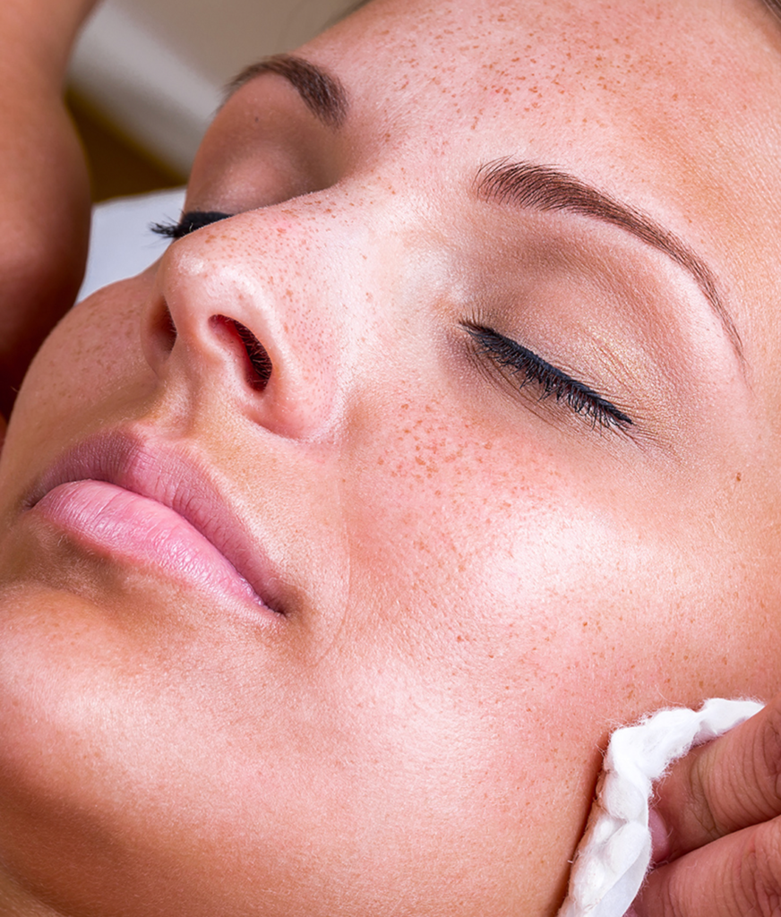 Freckle-faced woman receiving a TCA peel