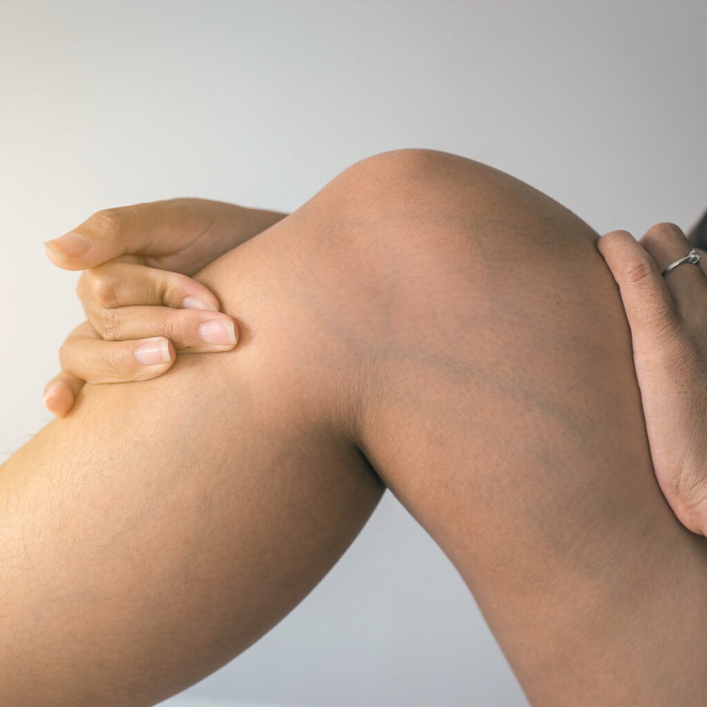 Photo of a woman's leg with visible veins